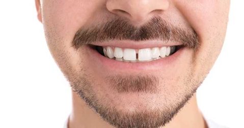 diastema